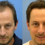 کلینیک بهسیما Medicine کاشت موی طبیعی به روش FIT و SUT در تهران با کمترین هزینه کاشت مو ارزان ، قیمت کاشت هر تار مو ، کاشت مو بدون جراحی ، هزینه کاشت موی سر